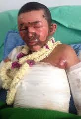 طفل اليمن المعجزة قد يفقد ساقه وأصابعه 