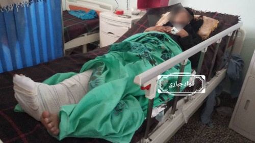 إصابة امرأة حامل برصاصة قناص #حوثي شمال غرب #الضالع