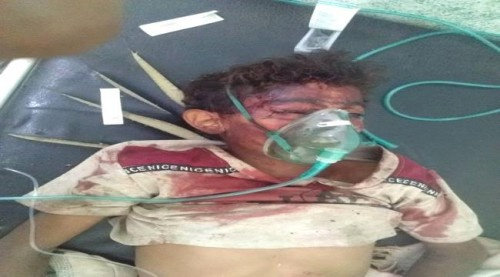 معظمهم أطفال ونساء.. مجزرتان حوثيتان في حيس والتحيتا ب#الحـديدة ضحيتهما 17 مدنيا 
