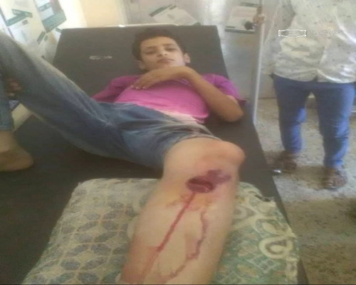 إصابة 4 مدنيين ببقايا مقذوفات متفجرة في حادثين منفصلين شمال وشمال غرب الضالع