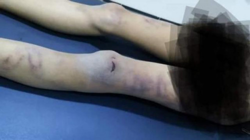 وفاة طفل بعد تعذيبه على يد زوجة أبيه في صنعاء