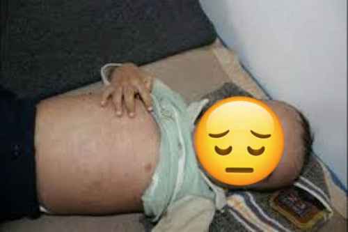 الحصبة تفتك بالأطفال والصحة تعجز عن مواجهة الكارثة