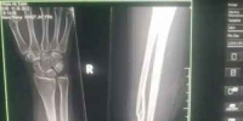 انتهاكات الحوثي مستمرة.. إصابة فتاة بعيارين لقناص شمال الضالع