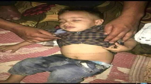 الحوثي يحول المستشفيات إلى مراكز الاتجار بالبشر