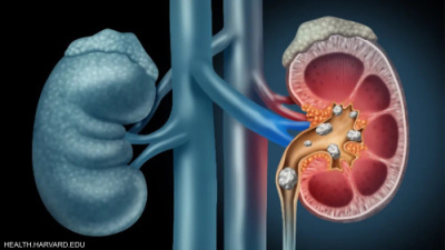 ثورة طبية.. الذكاء الاصطناعي يكشف سرطان الكلى في وقت قياسي